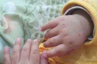 手足口病晚上睡觉哭闹不止怎么办？