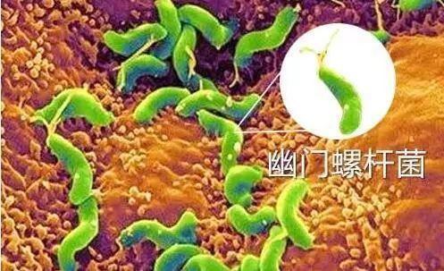 治幽门螺杆菌有了优化方法(图1)