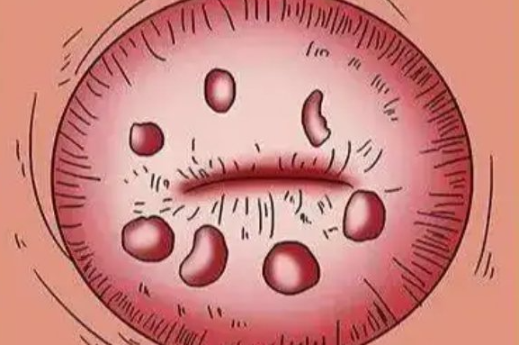 宫颈囊肿要治疗吗?生化妊娠多久能怀孕?