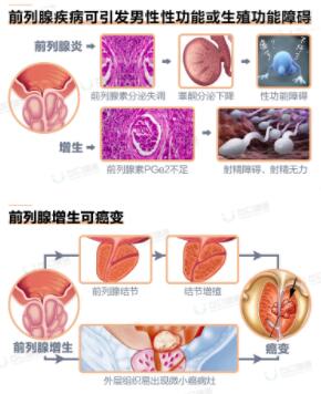毛向明教授:科学预防前列腺疾病是全体中国男性的社会责任(图3) 毛向明教授:科学预防前列腺疾病是全体中国男性的社会责任(图3)